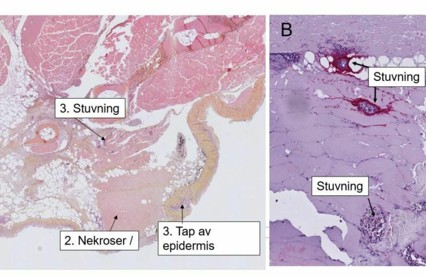 Bilde Til Sak Om Sår